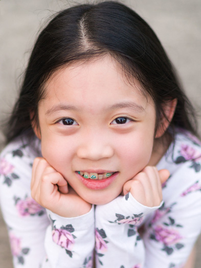 early orthodontic treatment